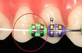 Broken Bracket