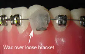 Wax Over Loose Bracket