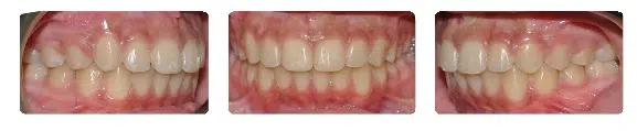 A close up of the teeth and gums