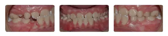 A close up of teeth with white spots on them