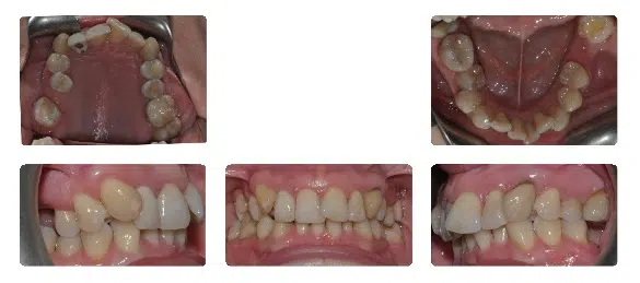A series of photos showing teeth and their different stages.