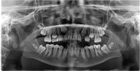 A black and white photo of teeth in the same position.