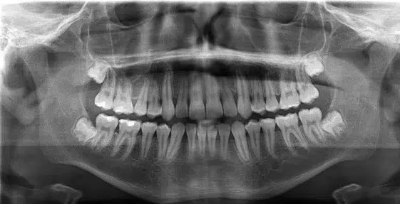 A close up of the teeth in an x-ray