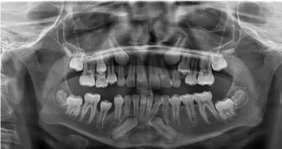 A close up of an x-ray showing teeth and gums.