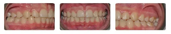 A close up of the teeth and gums