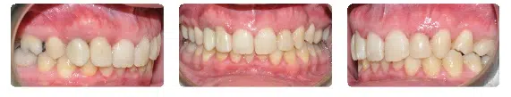 A close up of teeth with white fillings