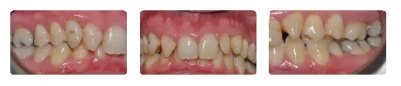 A close up of teeth with missing tooth