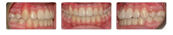 A close up of the teeth and gums