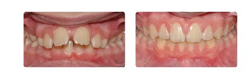 A before and after picture of the teeth that are missing.
