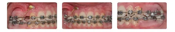 A close up of teeth with braces on them