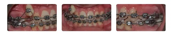 A close up of teeth with braces on them