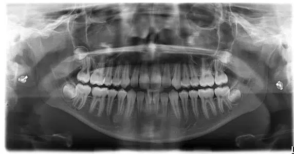 A black and white photo of teeth in an x-ray.
