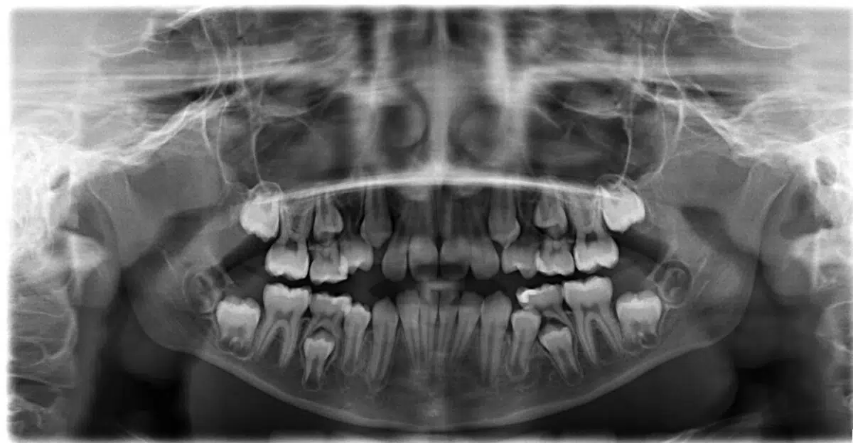 A black and white photo of an x-ray showing teeth.