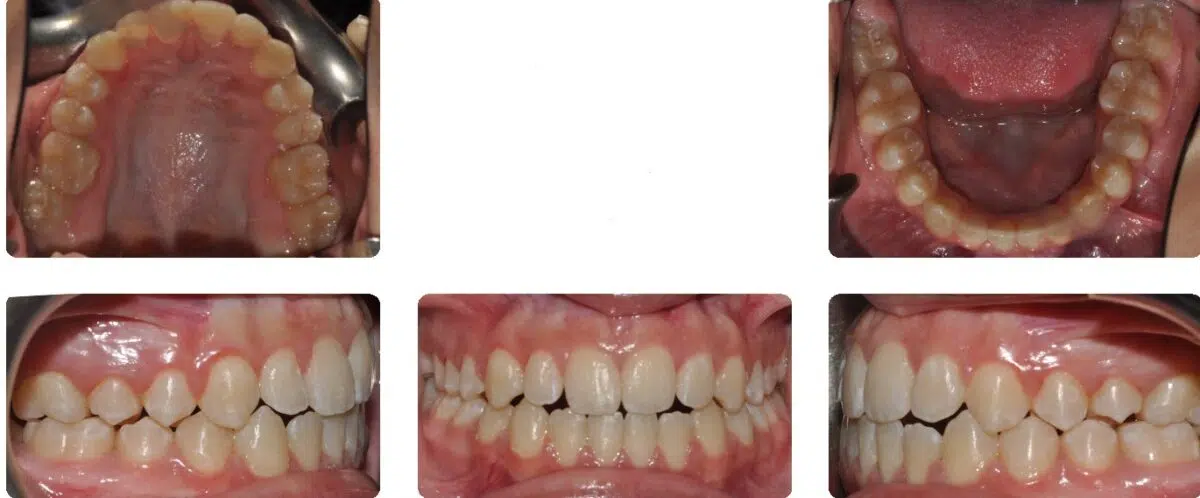 A close up of teeth and their different stages