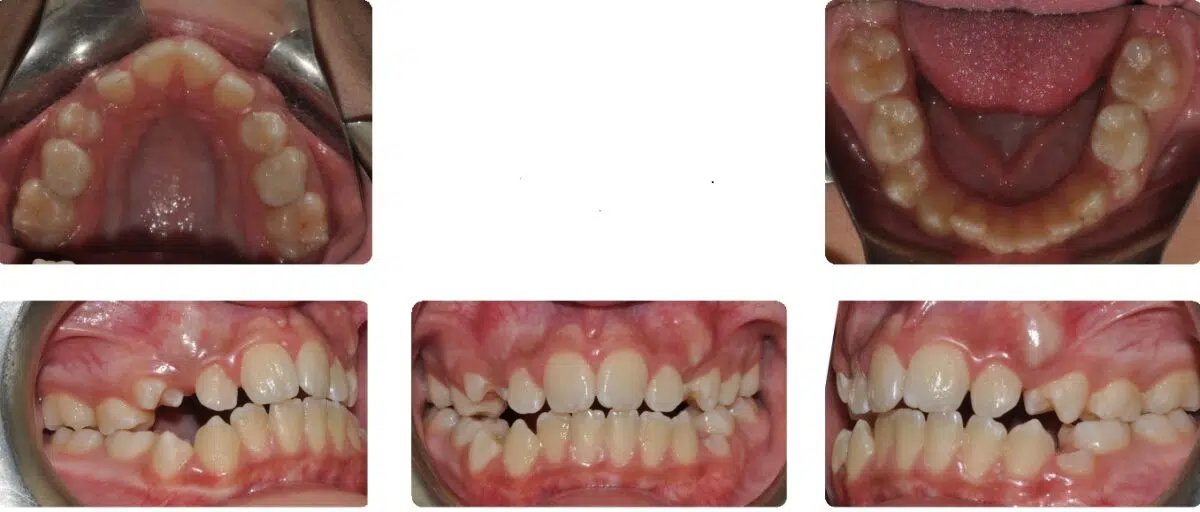 A series of photos showing the teeth and their progression.