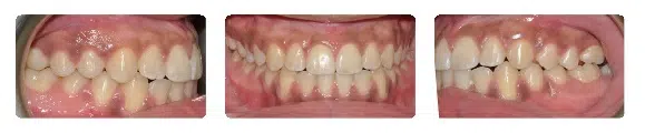 A close up of the teeth and gums