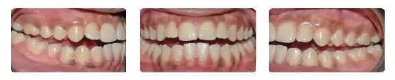 A close up of teeth with white fillings