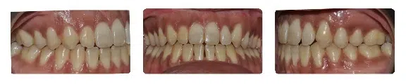 A close up of teeth with white spots on them