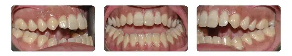 A close up of teeth with white fillings