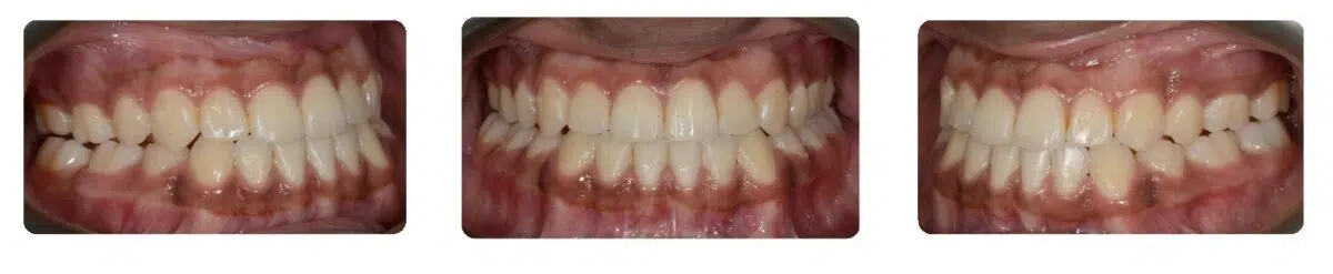 A close up of teeth with white spots on them