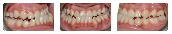 A close up of the teeth and gums