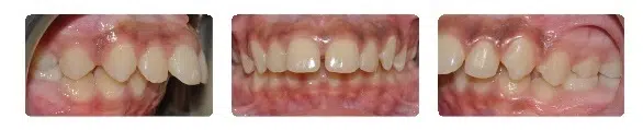 A close up of the teeth of a person