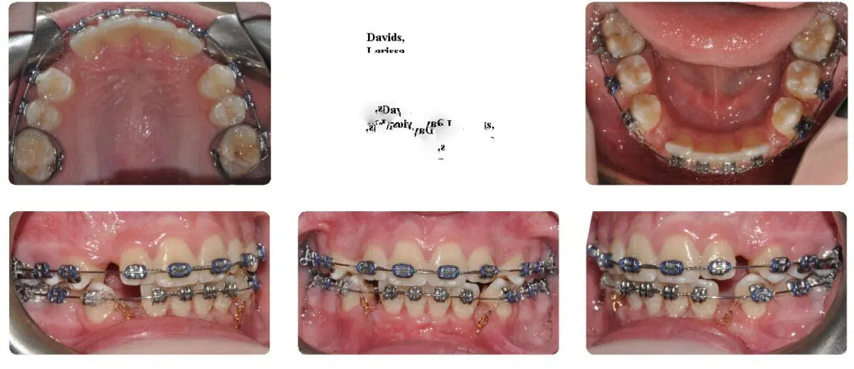 A picture of teeth with braces on them.