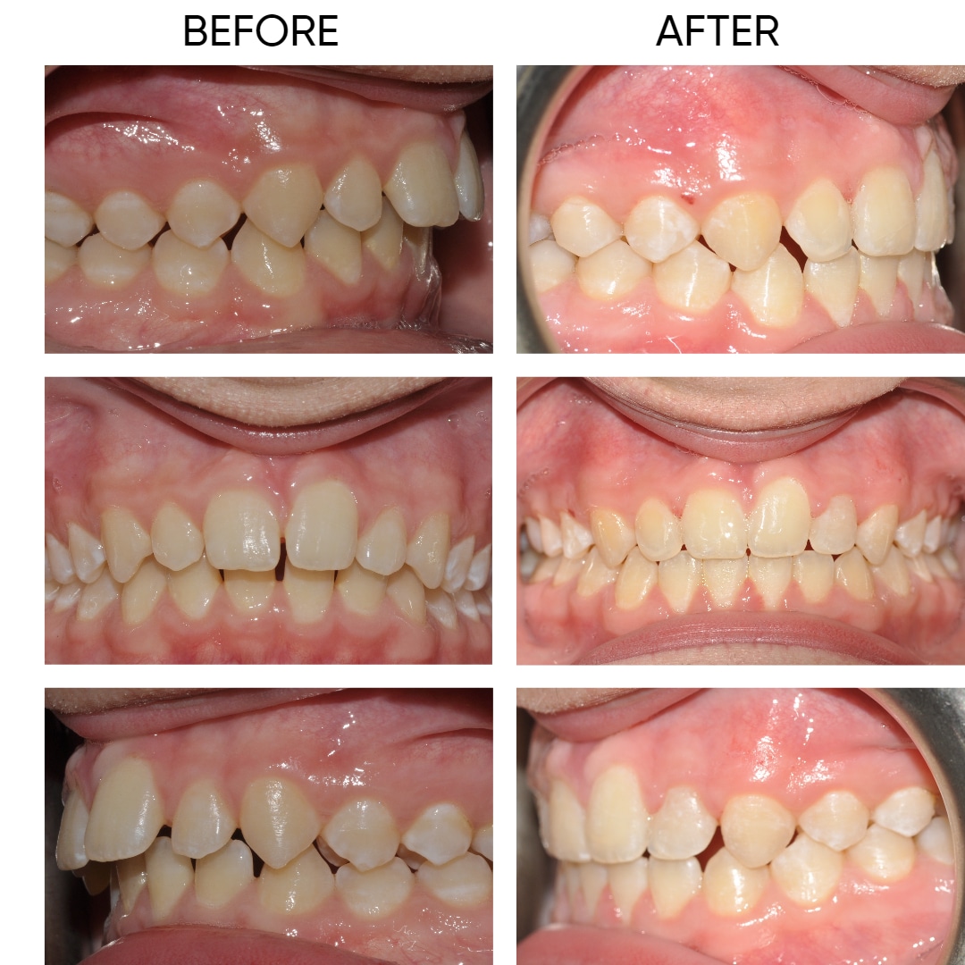 orthodontic treatment before and after