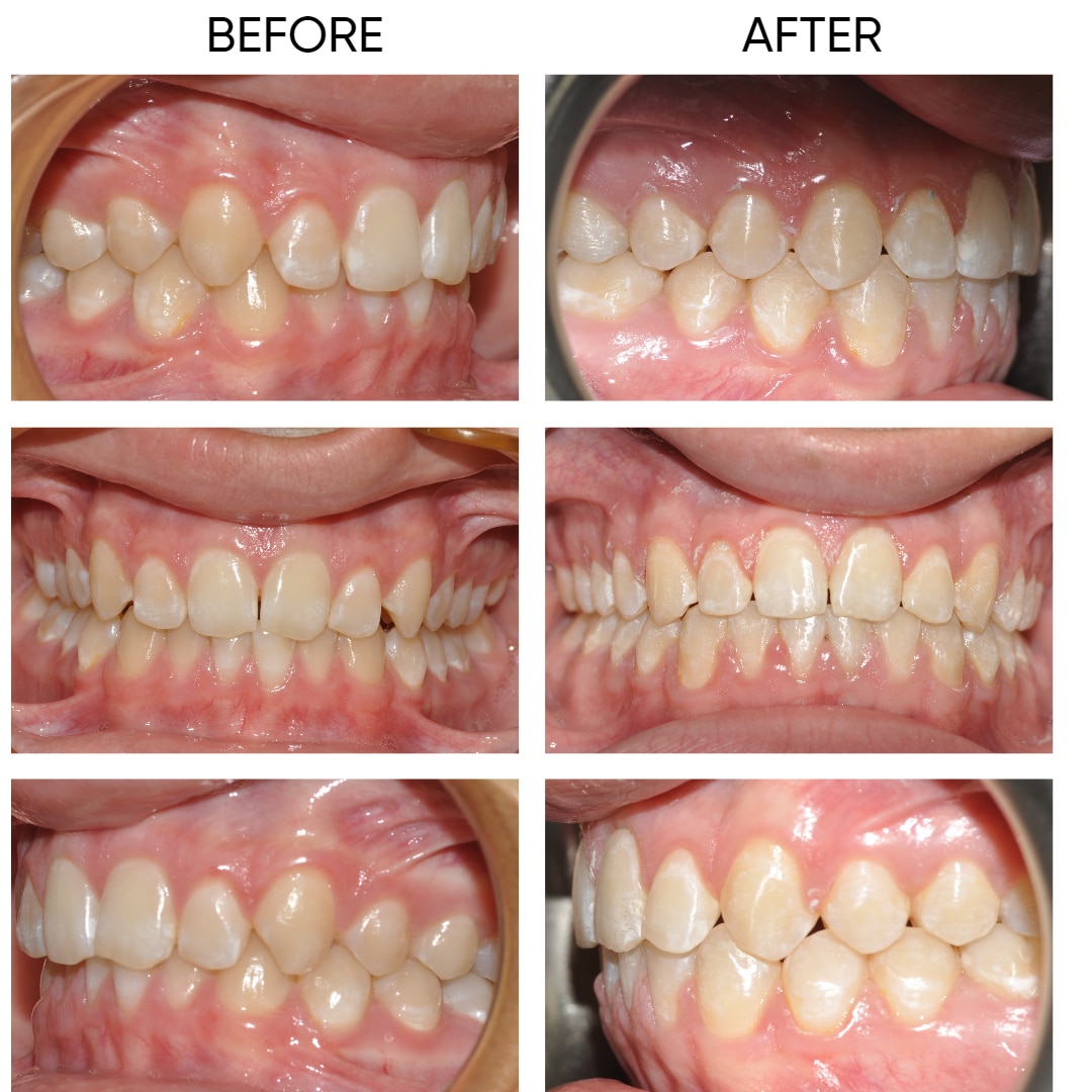 orthodontic treatment before and after